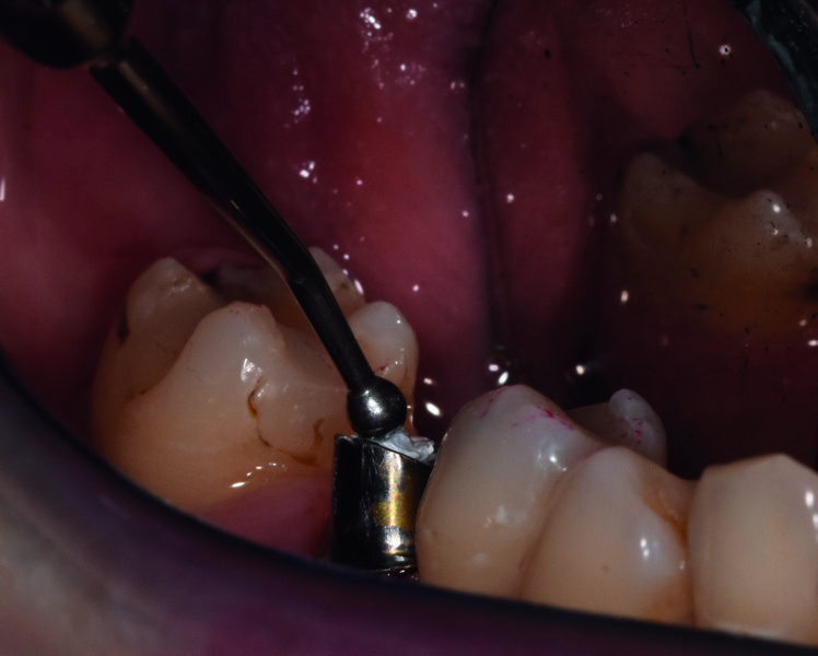 Fig. 25 : De l’autre côté : fouloir boule pour tasser le téflon. 
