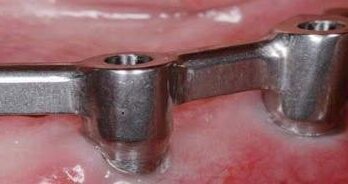 Leczenie bezzębia całkowitego – wskazaniem do zastosowania techniki CAD/CAM