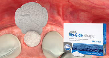 Geistlich Bio-Gide Shape: Preservazione della cresta minimamente invasiva in caso di difetti della parete vestibolare