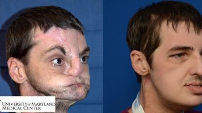 Amerikaner erhält nach Schussverletzung neues Gesicht Amerikaner erhält nach Schussverletzung neues Gesicht
