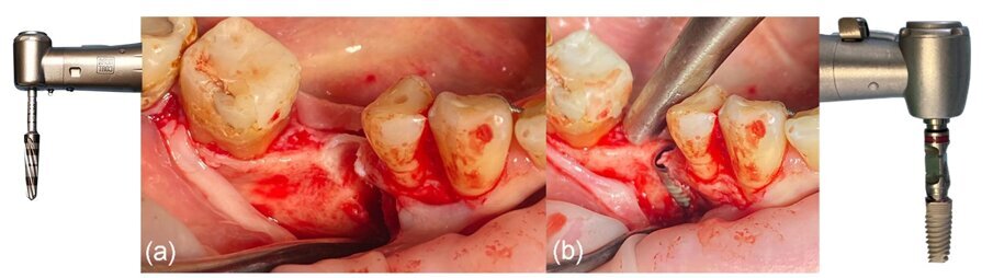 Fig. 6_a) Deiscenza vestibolare dopo la perforazione, b) situazione clinica dopo il posizionamento dell’impianto.