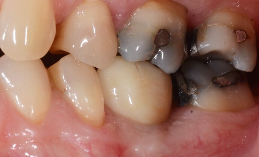 Fig. 21: One-year follow-up lateral view.