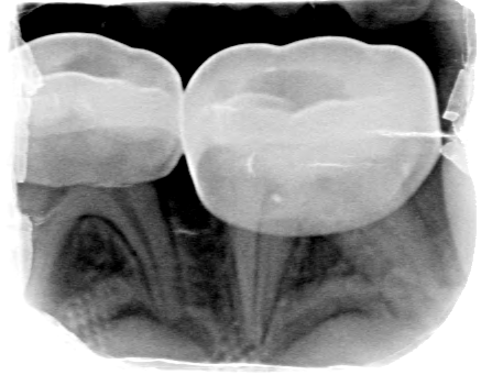 Afbeelding 3d: Röntgenfoto's op de leeftijd van 6 jaar, juli 2018.