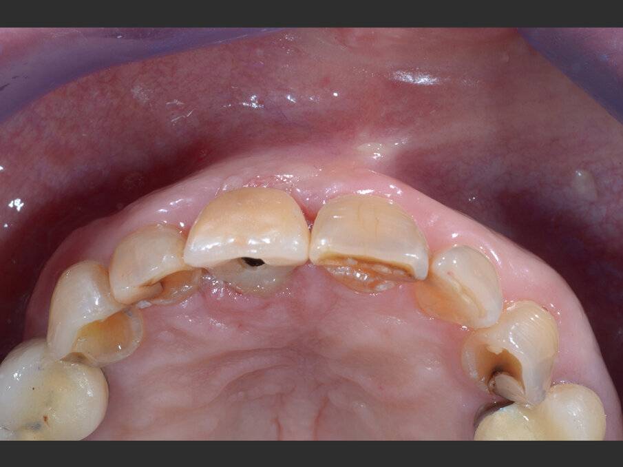 Fig. 6 - Valutazione post-operatoria con il provvisorio in situ - visione occlusale.