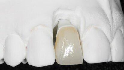 Indywidualizowane łączniki protetyczne konstruowane techniką CAD/CAM