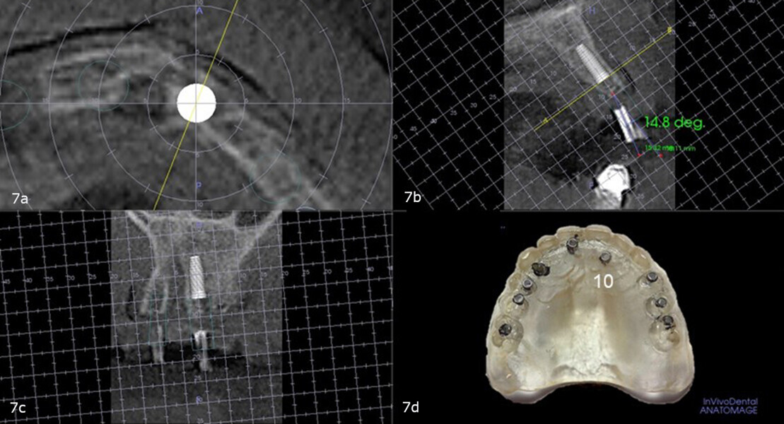 Figs. 7a–d: Virtual planning with the diagnostic guide placed intra-orally during the CBCT scan showing sufficient bone and the need for a 15° buccal correction to accommodate an implant in the maxillary left lateral incisor site (a–c). Site on the duplicate denture (d). 