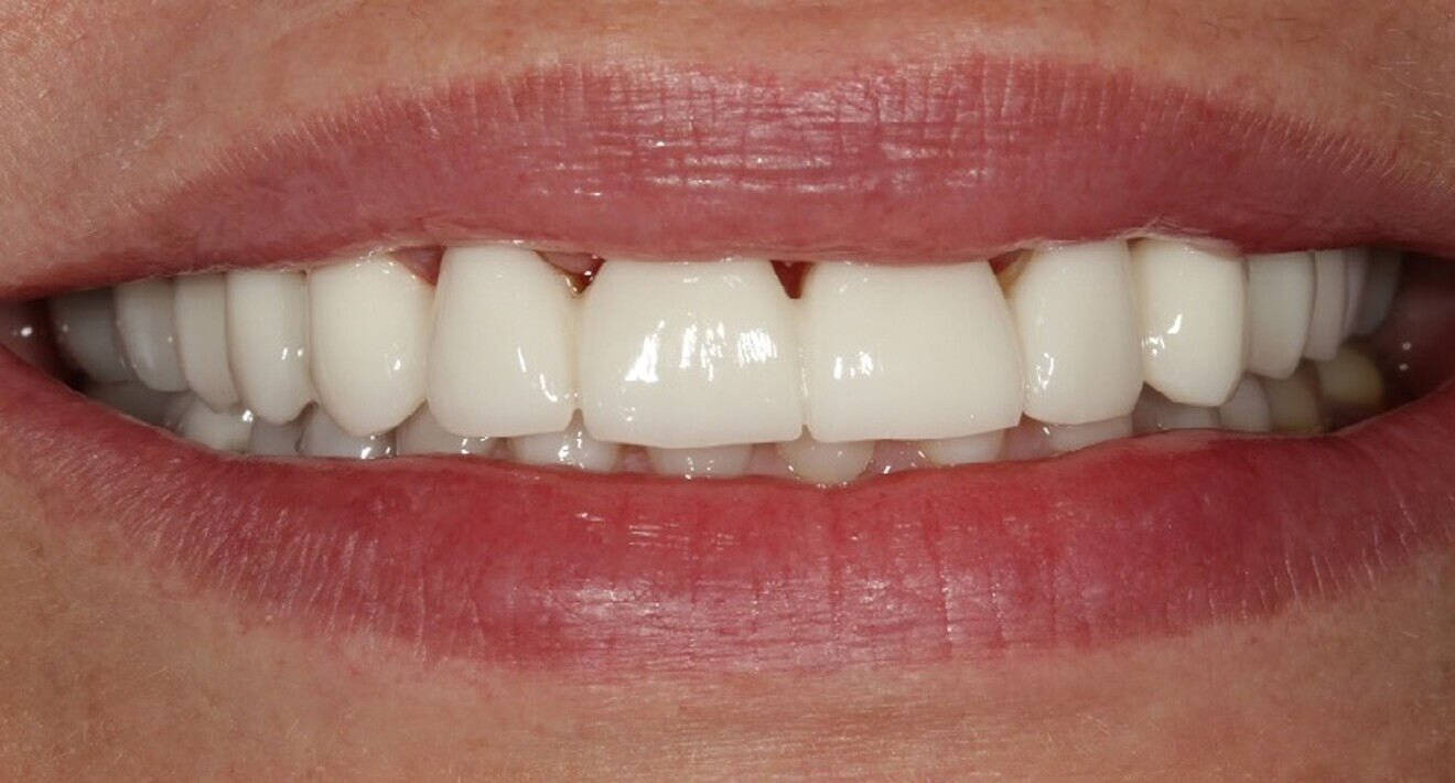 Fig. 13: Second PMMA prototype in place. Note the reflection of the facial surfaces of the second proposal compared with the first. While the first prototype was smoother in surface texture, the second proposal was more textured to accentuate the individual lobes of the facial surface.