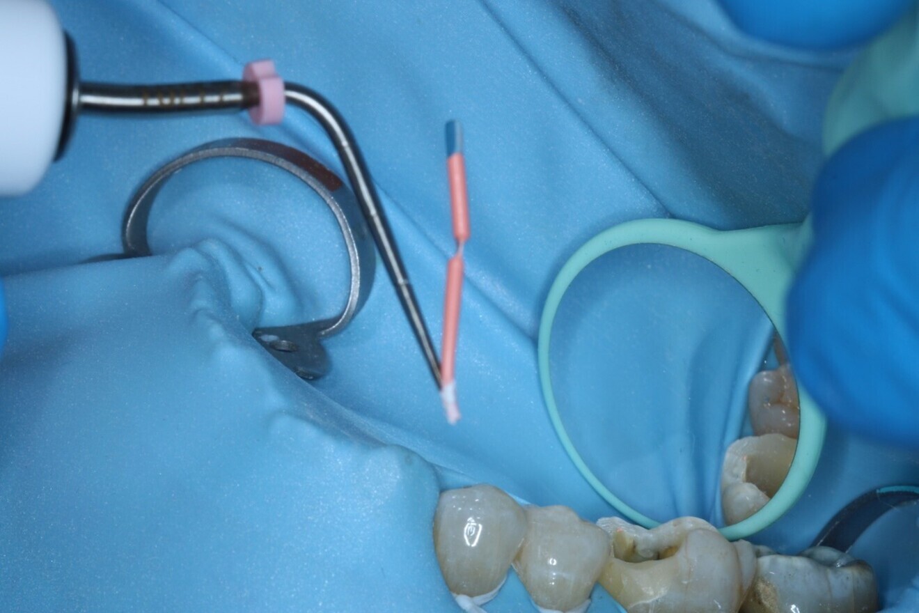 Fig. 13: Cutting of the coronal portion of the gutta-percha points using the System B Heat 