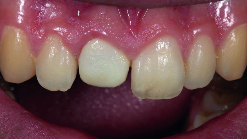 Fig. 4 : La sous-structure conseillée selon le calcul HO1 0,3 mm. 