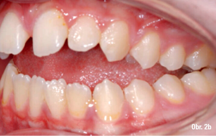 Laterálně otevřený skus často spojený s konstrikcí v horním zubním oblouku. Je často důsledkem sekundárního ústního dýchání a chronické dysbalance mezi pozicí jazyka a aktivitou m. buccinator (obličejové svalstvo).