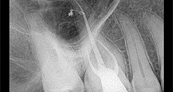 Efekat primene parcijalnog vakuuma na hemijsku obradu sistema kanala korena: Sleimanova faza