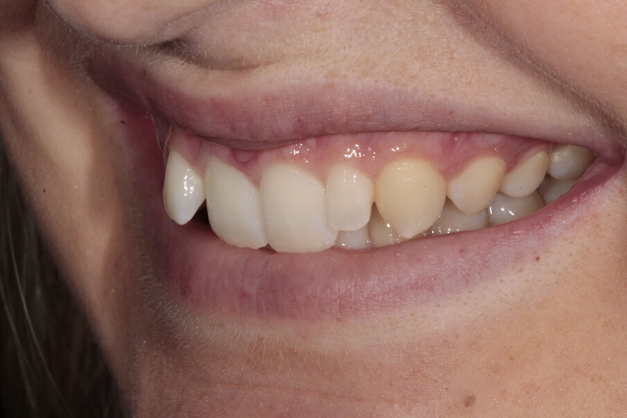 5. Initiële situatie, linker vooraanzicht