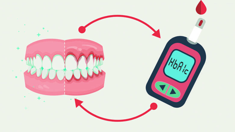 Conoscere e gestire efficacemente la correlazione tra diabete e parodontite