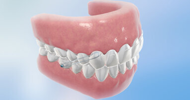 Align Technology présente Invisalign G3
