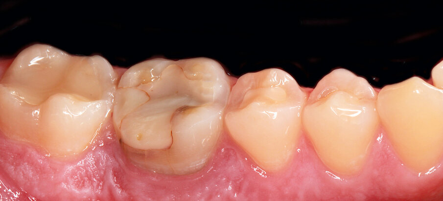 Fig. 30: The lower right 6 had been endodontically treated but could not be saved because of recurring inflammatory processes.