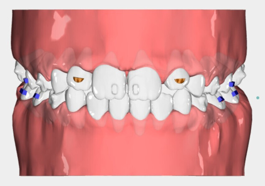 Fig. 8c: Nuvola View images of the impressions for the first phase of therapy, the second phase, the finishing design and the final re-evaluation of the case.