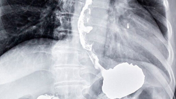 Un test sul respiro per diagnosticare il cancro dell’esofago e dello stomaco