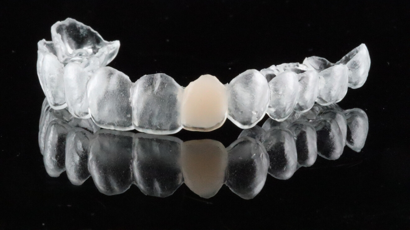 Fig. 6a: Completed provisional retainer incorporating a resin composite pontic.