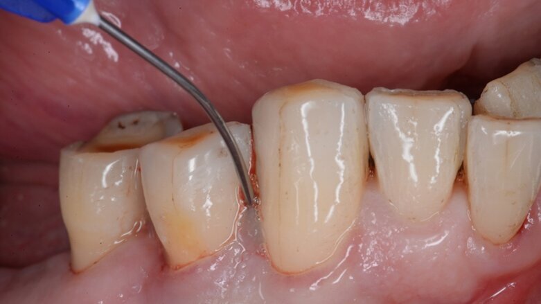 Drei Fragen zur Regeneration parodontaler Knochendefekte