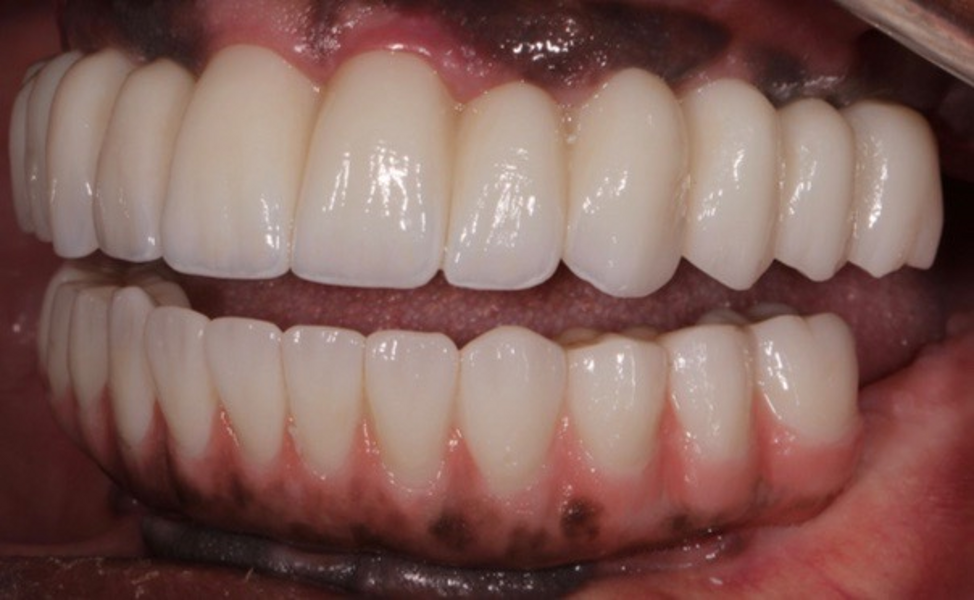 Fig. 35: Left lateral view of the completed case.