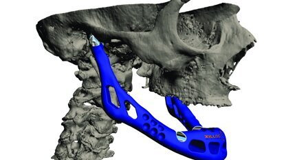 LayerWise construit le premier implant personnalisé de reconstruction mandibulaire totale
