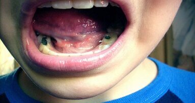 Kaakchirurgen trekken aan de bel over melkgebitten