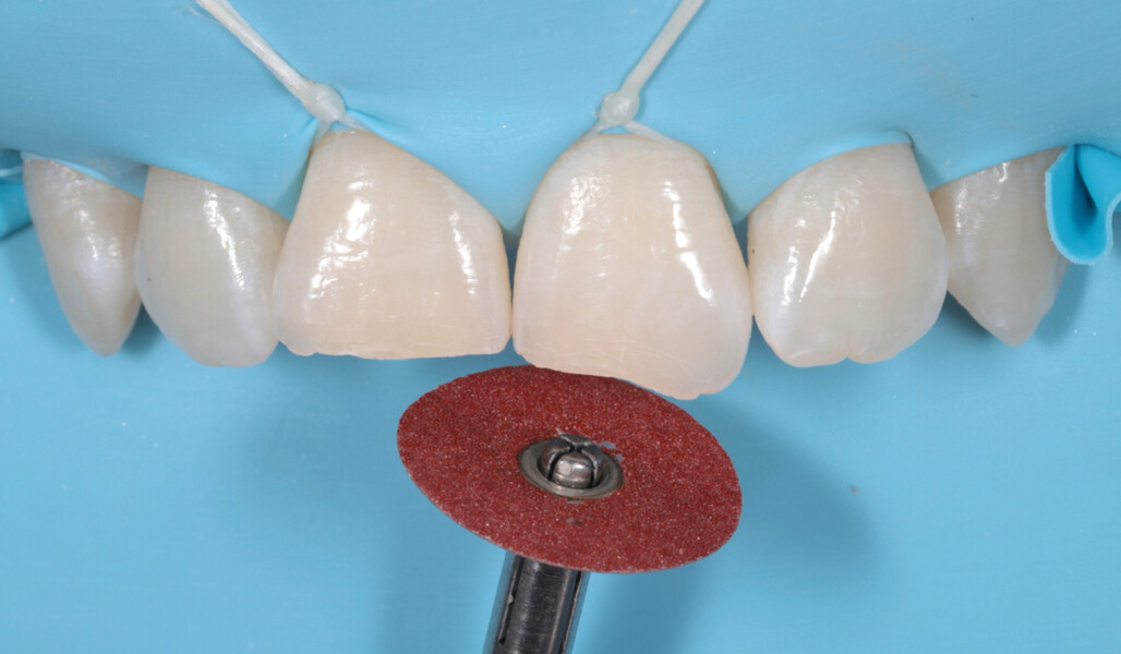 Fig. 8: Finishing of the preparation with a Sof-Lex disc.