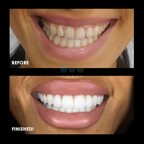 Figs. 40a & b: Patient’s smile (a) prior to any treatment compared with (b) after clear aligner treatment, veneers and soft-tissue recontouring.