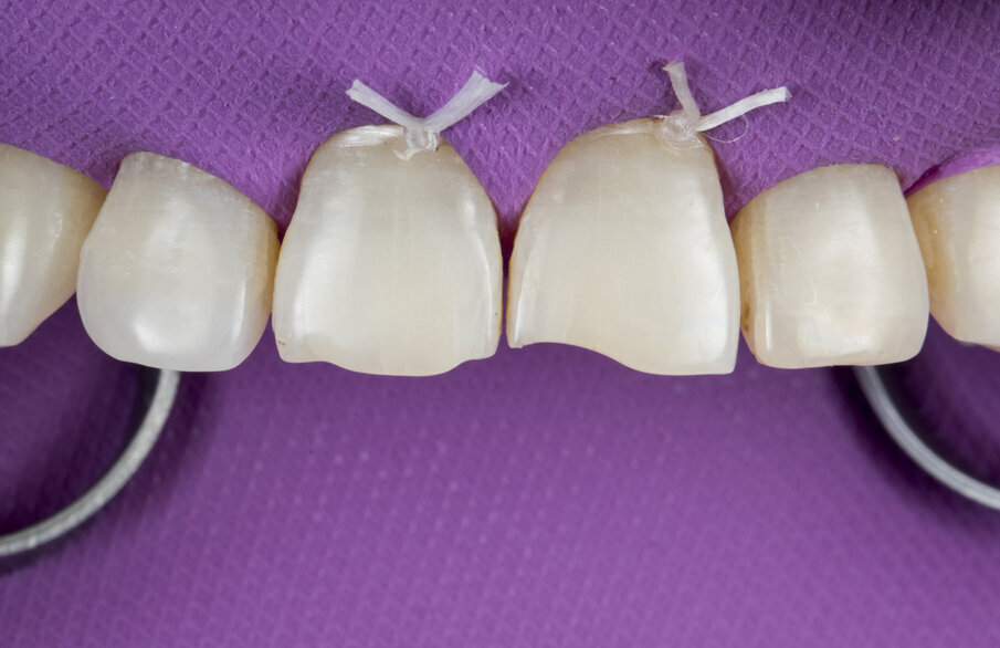 Fig. 4: Rubber dam isolation with floss ties