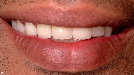 Functional reconstruction and aesthetic management of the anterior maxillary segment