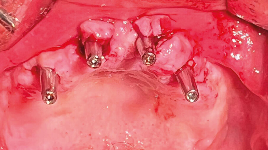 Fig. 9 - Foto vista completa dopo aver inserito i monconi.