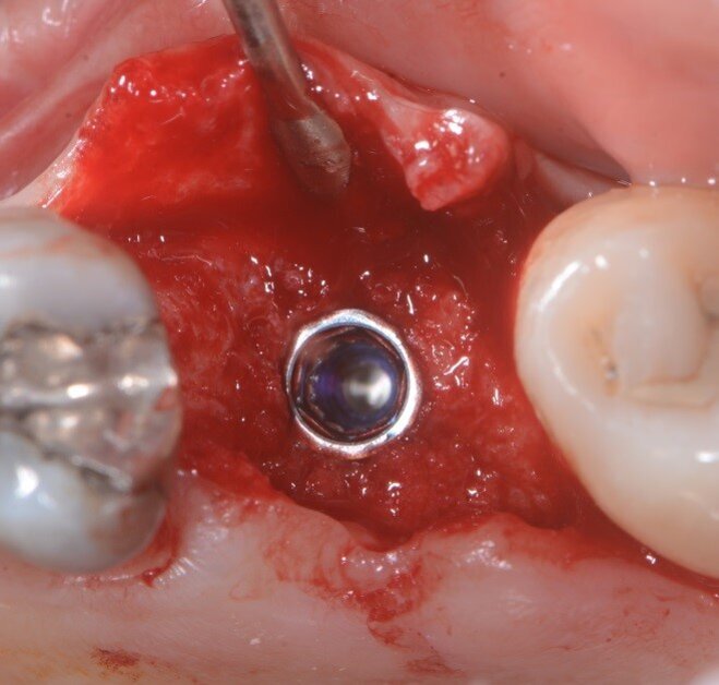 Fig. 10 - Impianto inserito.