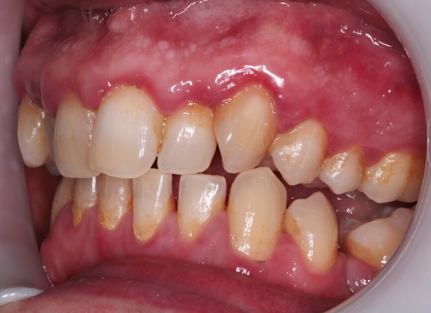 Fig. 3: Pre treatment left lateral