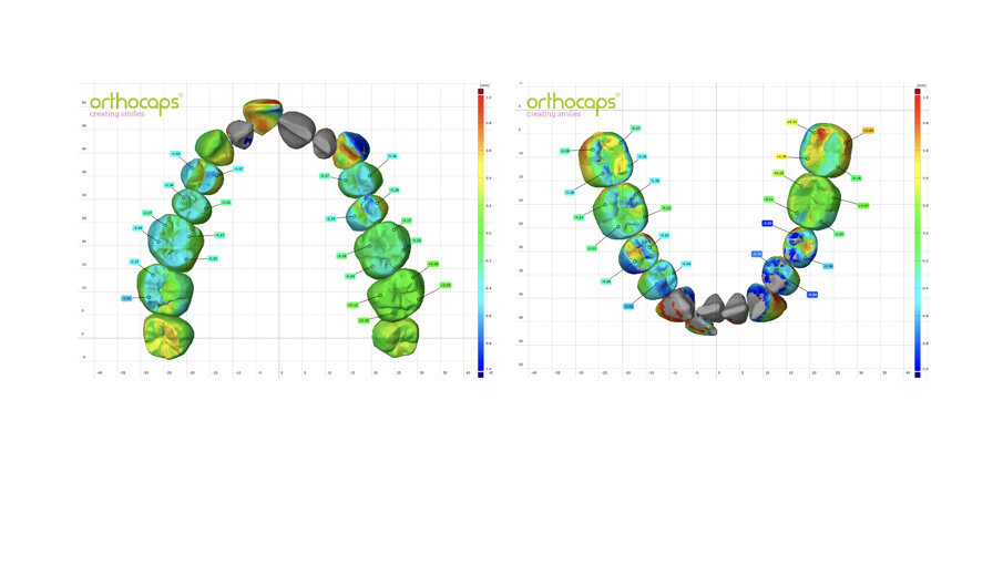 Fig. 61_L’analisi della deviazione ha mostrato l’intrusione dei denti posteriori, come previsto. I denti in grigio non sono stati inclusi in questa analisi, poiché la quantità di movimento superava l’intervallo di 1 mm selezionato per questa sovrapposizione.