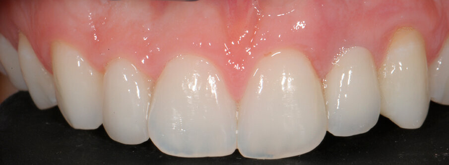 Fig. 8a - Caso concluso con veeners in ceramica a livello del 22.