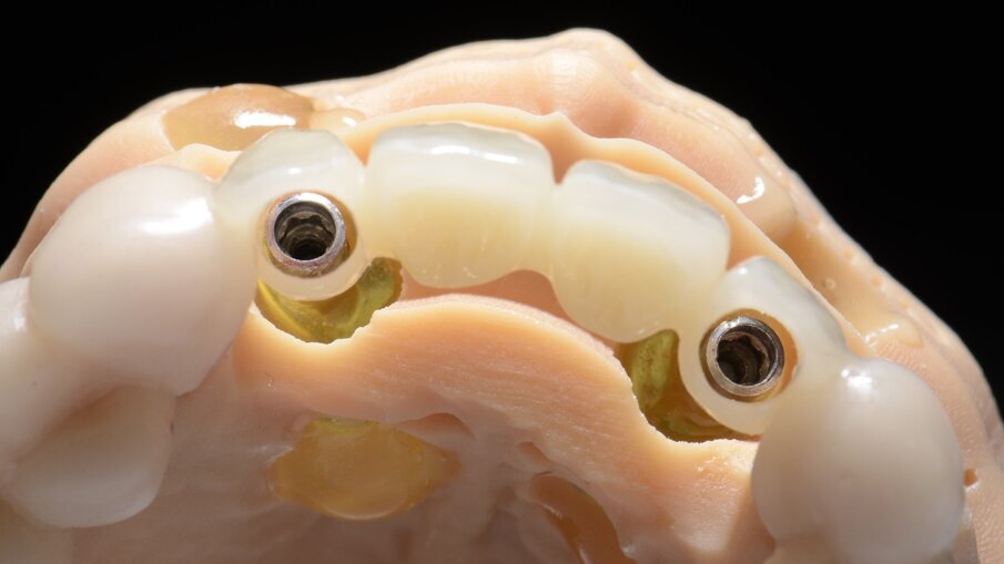 Fig. 46 - Visione occlusale provvisorio