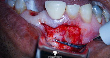 Calcium silicate-based endodontic materials: A clinical perspective