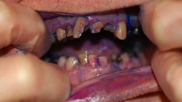 Dental hygiene for dependent adults