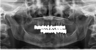 Impianti in paziente con terapia farmacologica per infiammazione renale e inizio di osteoartrosi: cortisoni a lungo termine