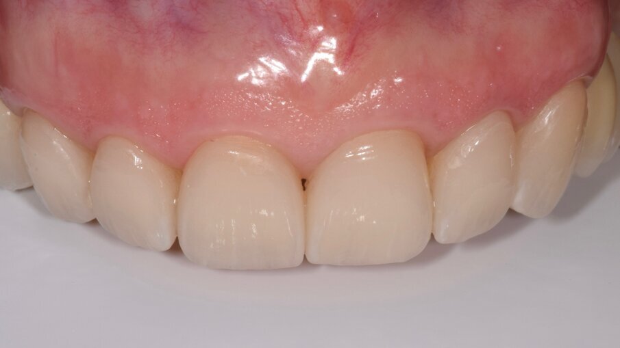 Fig. 12: Bonded partial fixed dental prostheses at the recall appointment.
