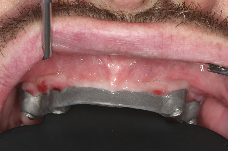 ... and with a printed wax-up (16b).