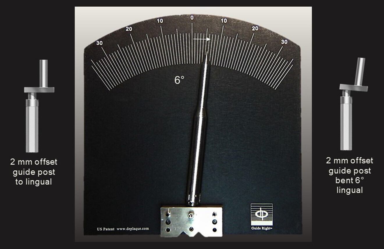 Fig. 12: First angle correction made utilising the bending tool to bend the offset guide post 6° in the lingual direction.
