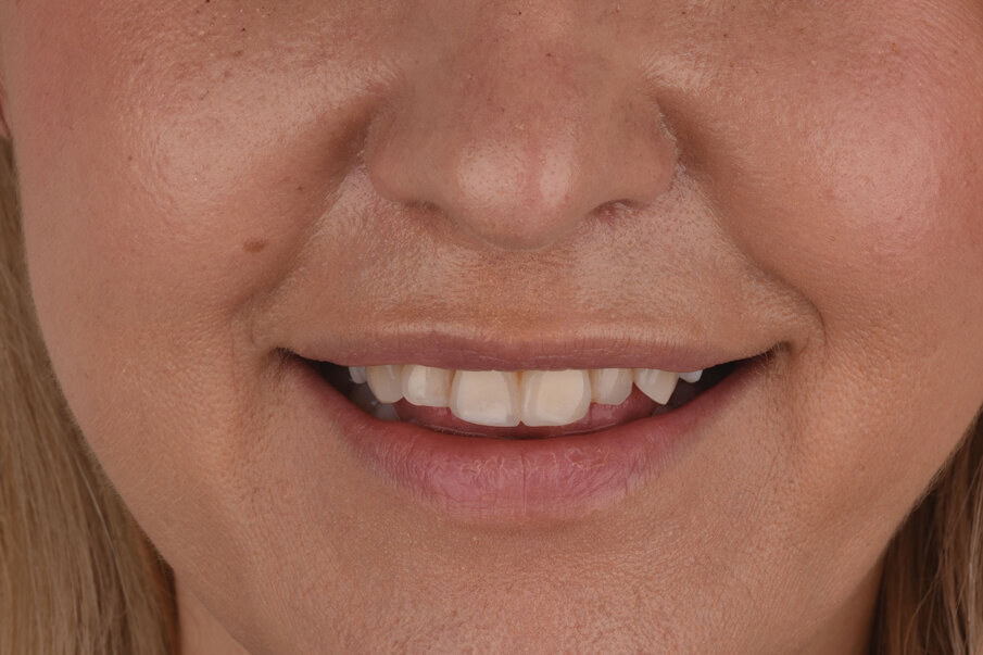 Sl. 18: Završna obrada i poliranje restauracije