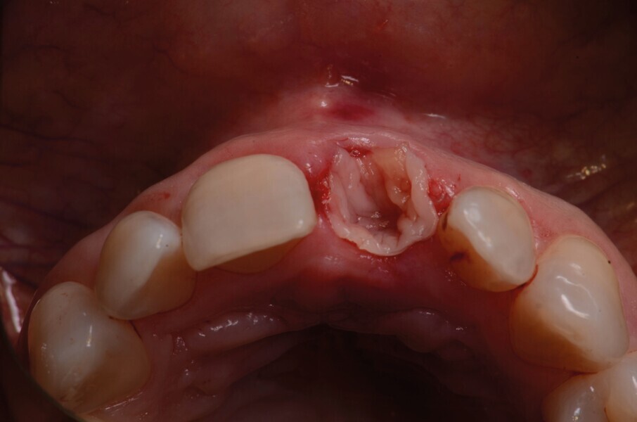 Fig. 6 : L’alvéole est recouverte avec une membrane L-PRF. 