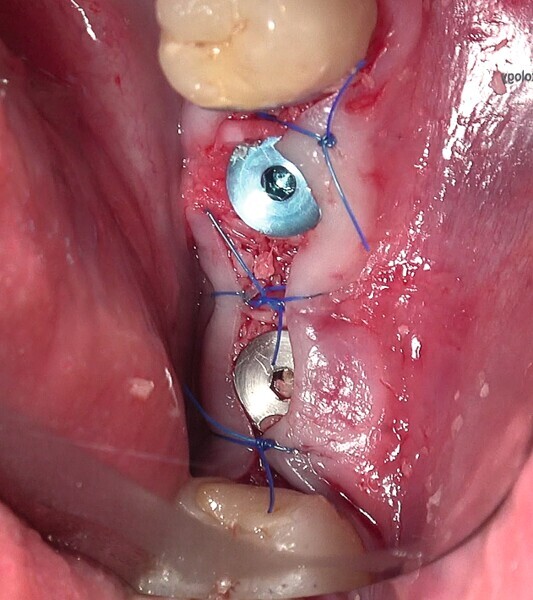 Fig. 33 : Mise en place d’une membrane de collagène à titre de barrière de protection et suture. 