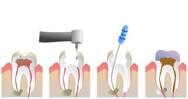 Novo método pode substituir o tratamento de canal