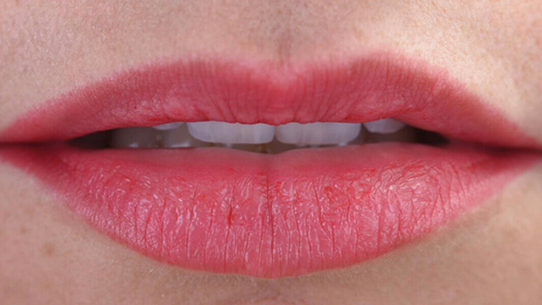 Fig. 17c. Labios en reposo, exposición de los bordes incisales.