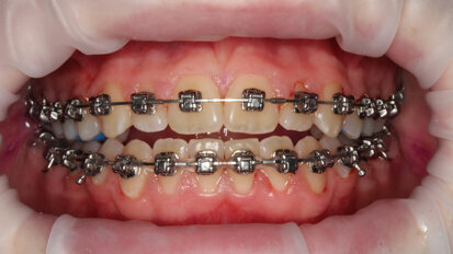Pacientul ortodontic – Din iad în rai.