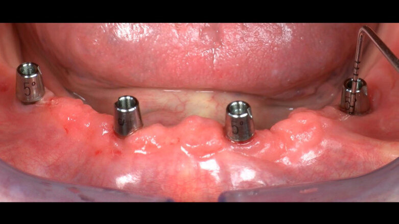 Implant-supported mandibular complete prosthesis with conometric retention after three years