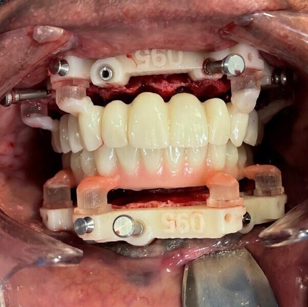 Fig. 16: Maxillary and mandibular key fixation foundation guides made from Flexcera with indexed transitional Flexcera Smile prostheses prior to pick-up.